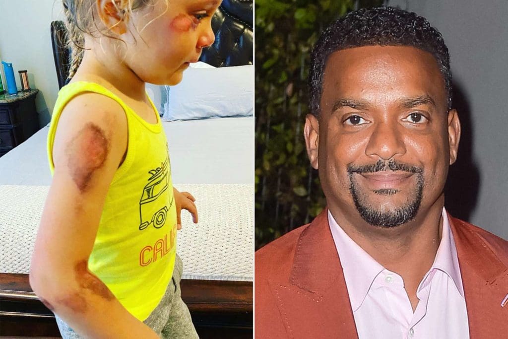 Alfonso Ribeiro Says Daughter 4 Faces Long Recovery After Doctor Scalpeled Skin Following