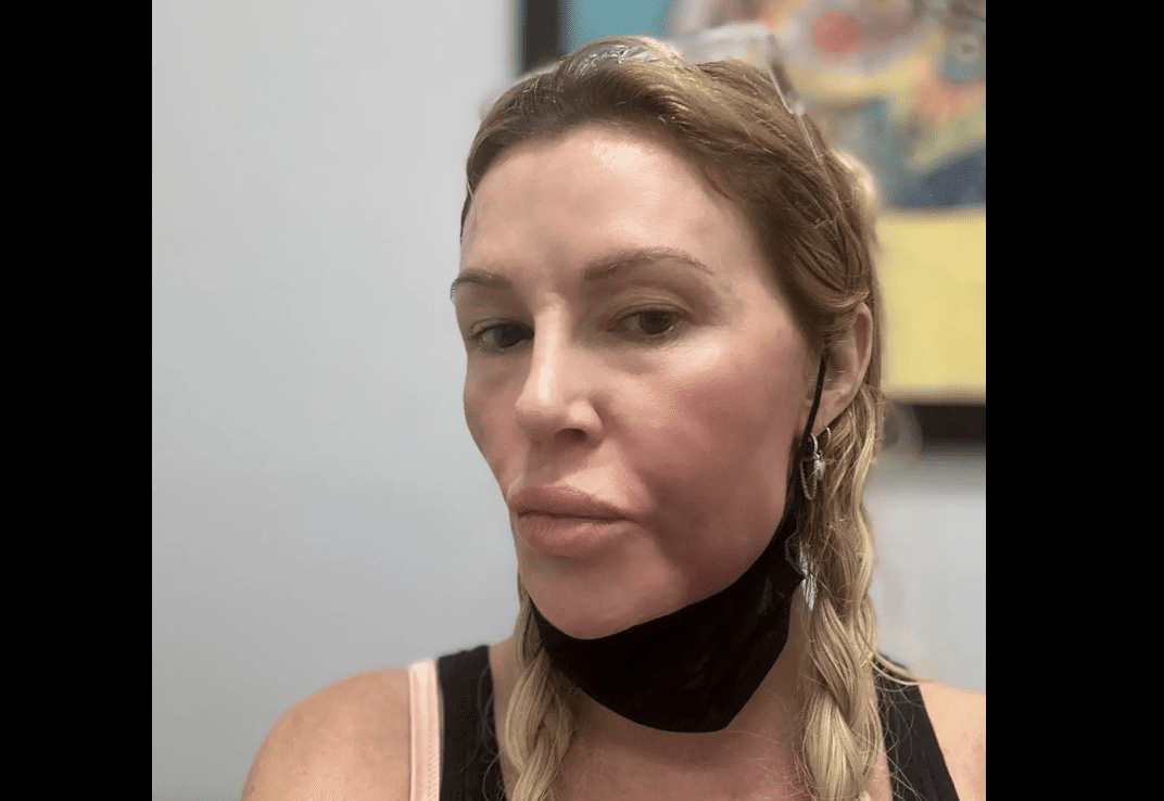 Brandi Glanville Blames Bravo for Facial Swelling: ‘I Couldn’t Even Work If I Wanted To’