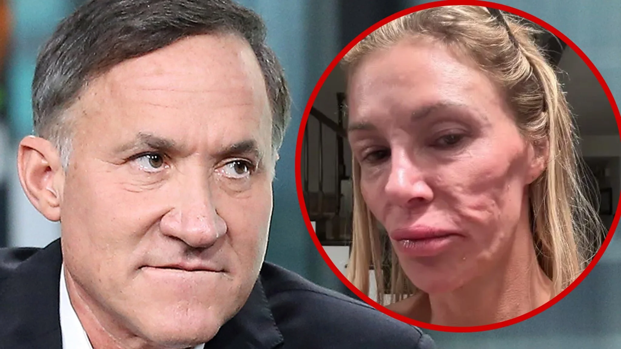 ‘Botched’ Surgeon Dr. Terry Dubrow Says Brandi Glanville’s Face Isn’t Because of Parasite